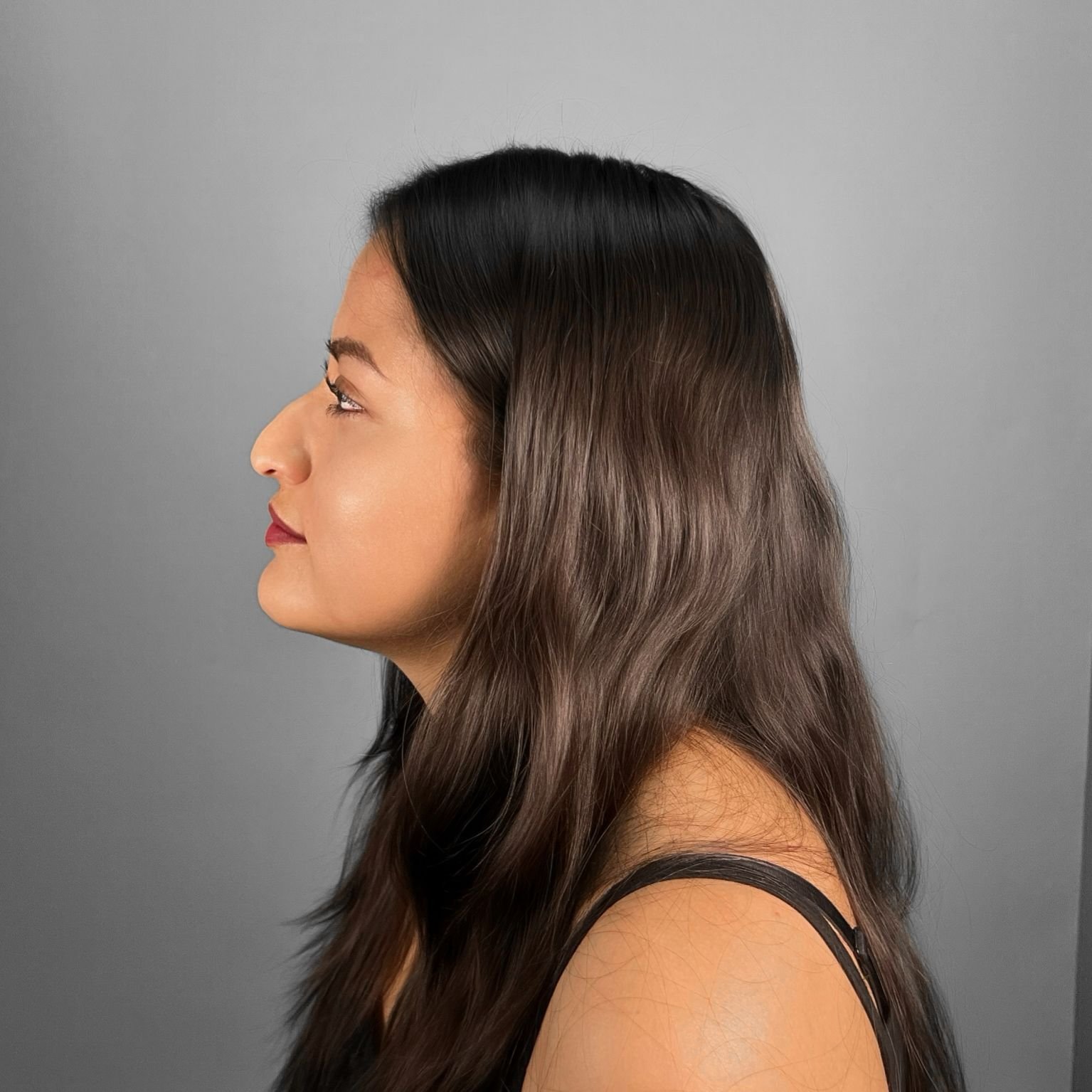 Antes de rinoplastia — caso real paciente femenina